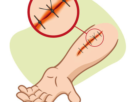 Close up of stitched up wound