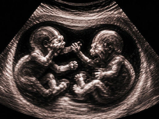 an ultrasound showing two babies fighting