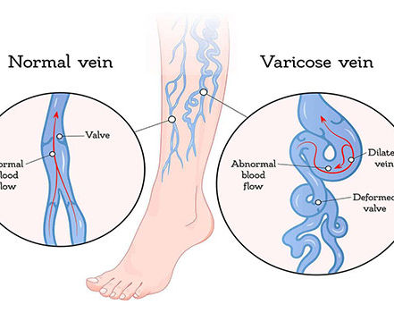 Varicose-Veins #COMSClinic.jpg
