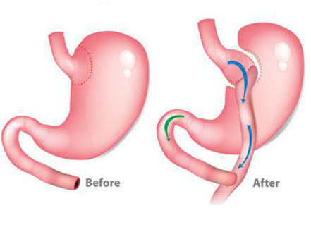 Gastric-Bypass-Surgery #COMSClinic.jpg