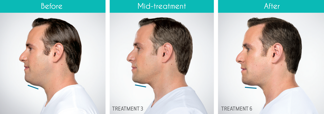 Kybella Male Before and After.png