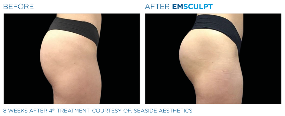Emsculpt_PIC_Ba-card-female-buttock-094_ENUS100.png