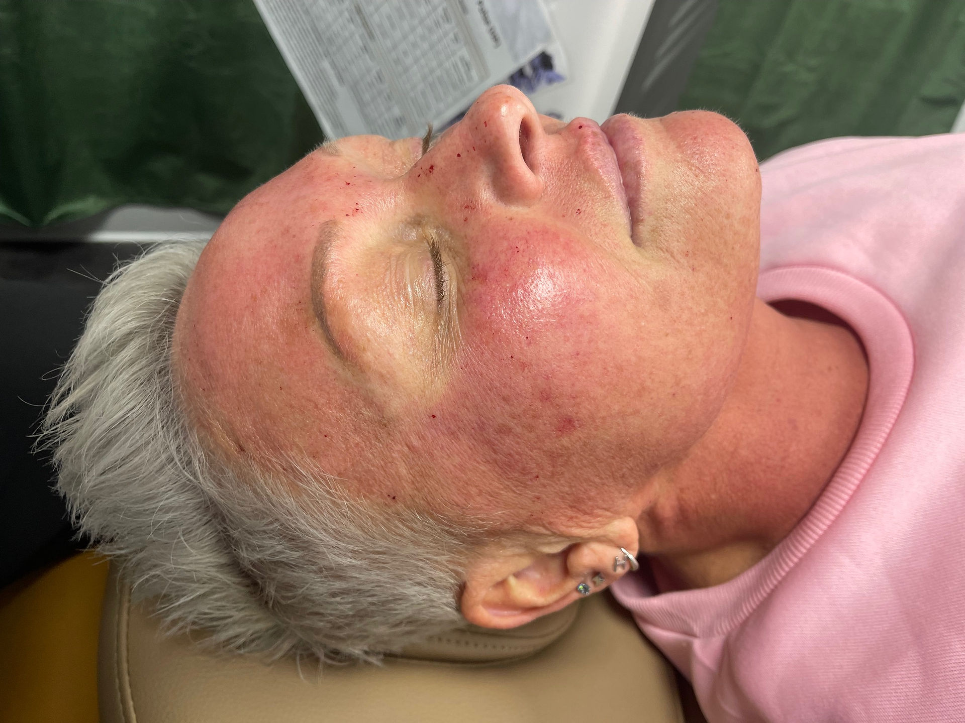 RF Microneedling Fredericksburg VA