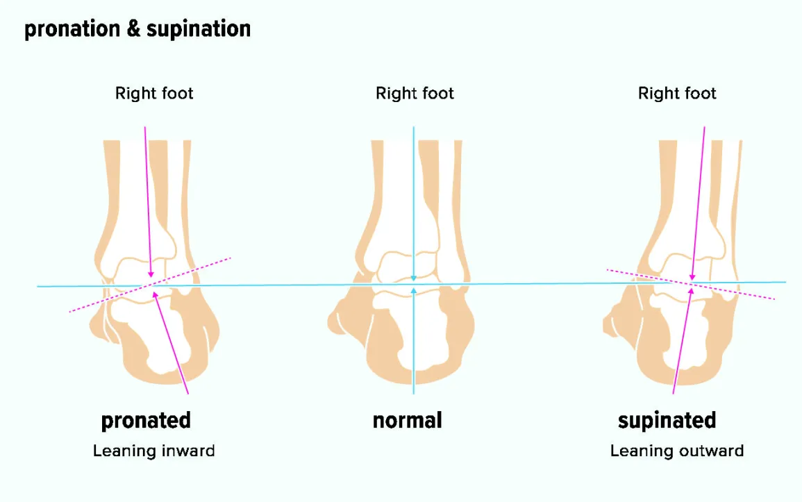 demonstration of excessive pronation on the foot gait