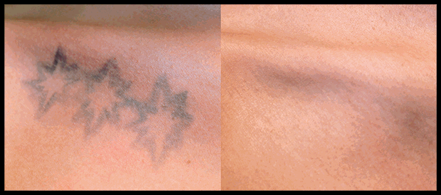 BA-PicoSure-SkinpossibleLaserLight-Post1Tx-3stars1