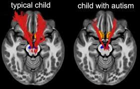Autism and AI the connection