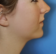 Hun Nase_Kinn Aufbau post blau .PNG