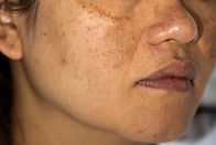 Skin problem Melasma and acne scars on Young Asian womenShe has hyperpigmentation on her b
