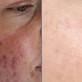 acne.jfif