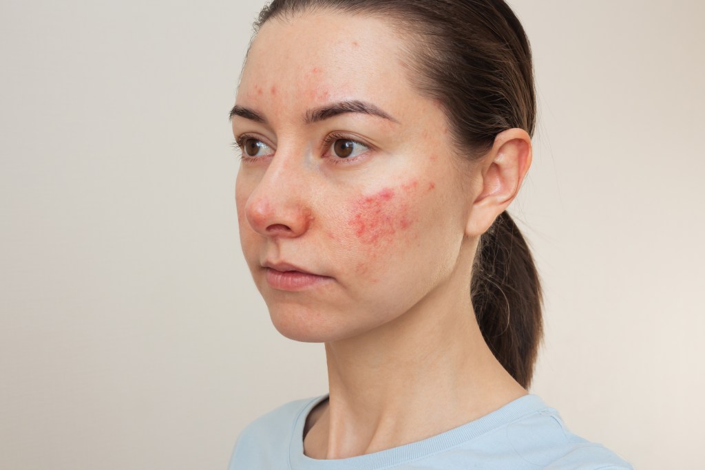 How to Care for Sensitive Skin All Year Long?