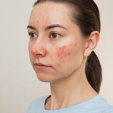 How to Care for Sensitive Skin All Year Long?