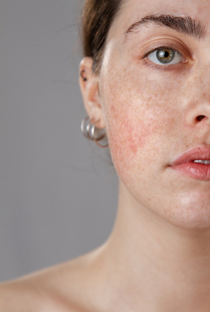 How To Calm Rosacea-Prone Skin?