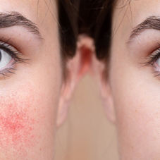 How to Spot Couperose Skin (Before It Takes Over Your Face)