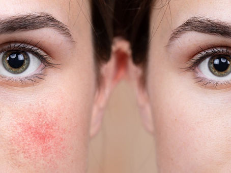 How to Spot Couperose Skin (Before It Takes Over Your Face)