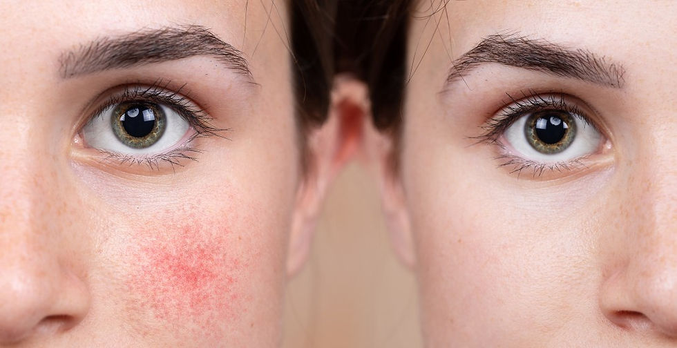 How to Spot Couperose Skin (Before It Takes Over Your Face)