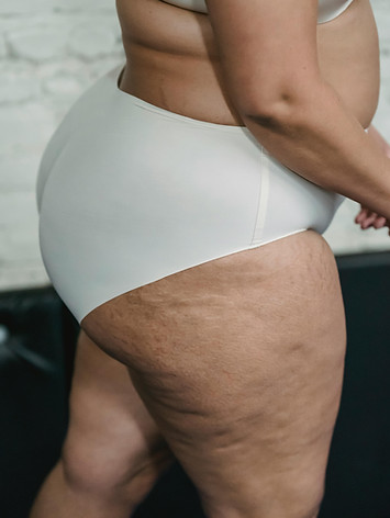 lipedema.jpg