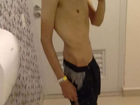 Bullying levou Lucas a anorexia e agora ele precisa de ajuda para tratamento