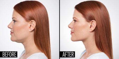 kybella-before-after.jpeg