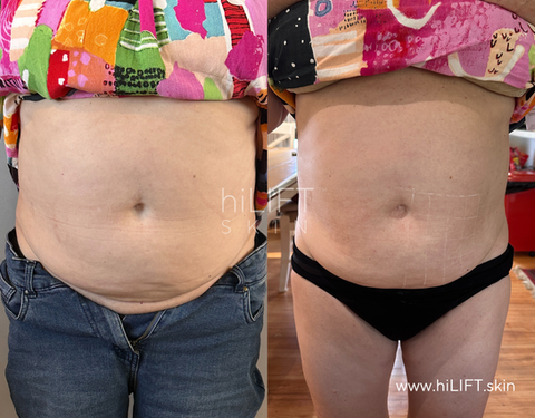 Abdomen HIFU