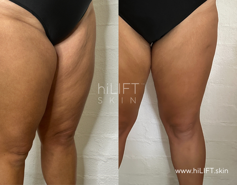 Legs HIFU