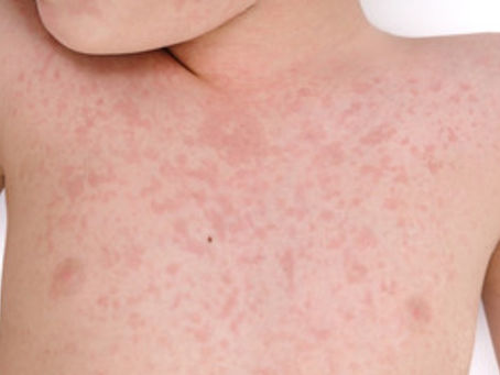 Health Department: 10 Measles Cases Confirmed in Texas