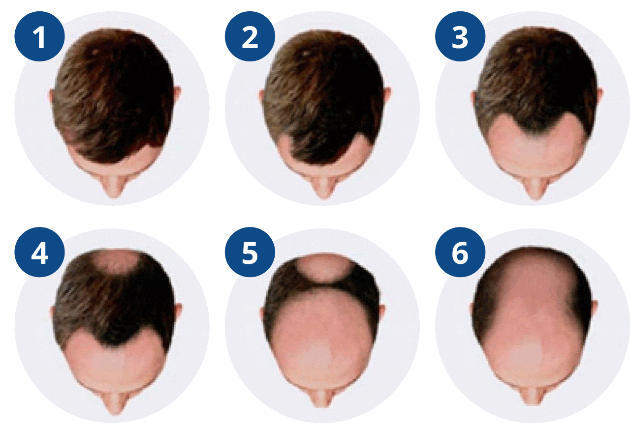 Mannen: als eerste worden de inhammen en kruin dunner behaard. Daarna volgt het grootste gedeelte van de bovenzijde van het hoofd.