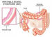 Appendicitis