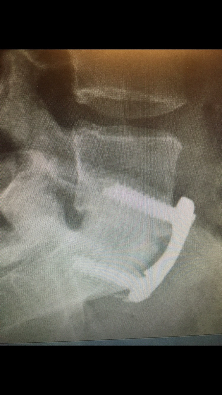 Anterior Lumbar Interbody Fusion (ALIF)