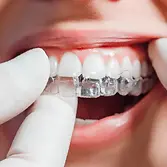 invisible aligners