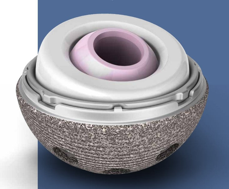 Stryker MDM® X3 Modular Dual Mobility Acetabular System. Catalog 1236