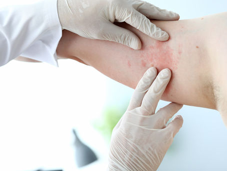 Alergia de pele: conheça as principais causas