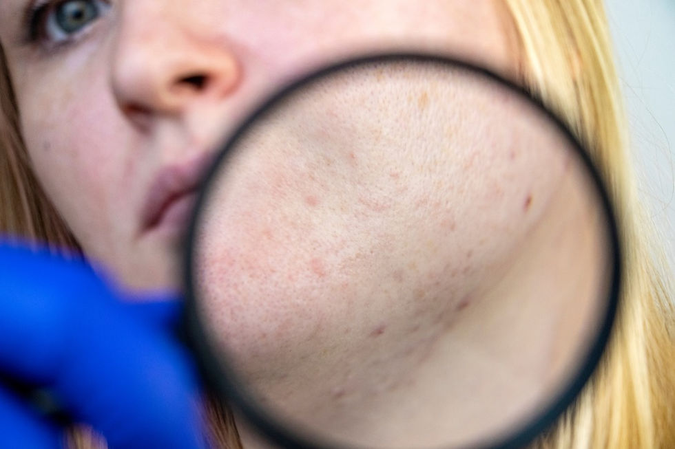 Post-Inflammatory Hyperpigmentation, PIH