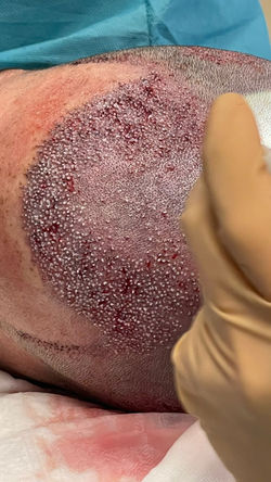 Microinjerto capilar Durban medicina capilar 1