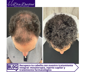 Recupera tu cabello en Madrid con nuestro tratamiento integral