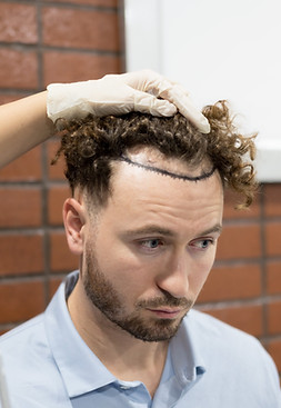 Greffe de cheveux Ligne frontale.JPEG
