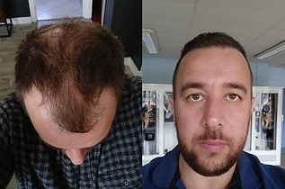 greffe de cheveux avant après .png