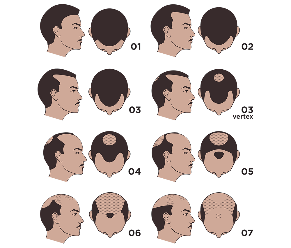 greffe de cheveux Turquie