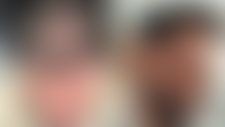 Greffe de cheveux : évolution mois par mois