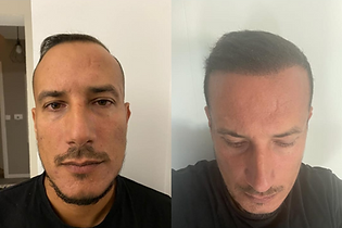 greffe de cheveux avant après .png
