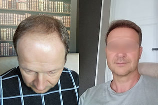 greffe-de-cheveux-turquie-resultat.jpg