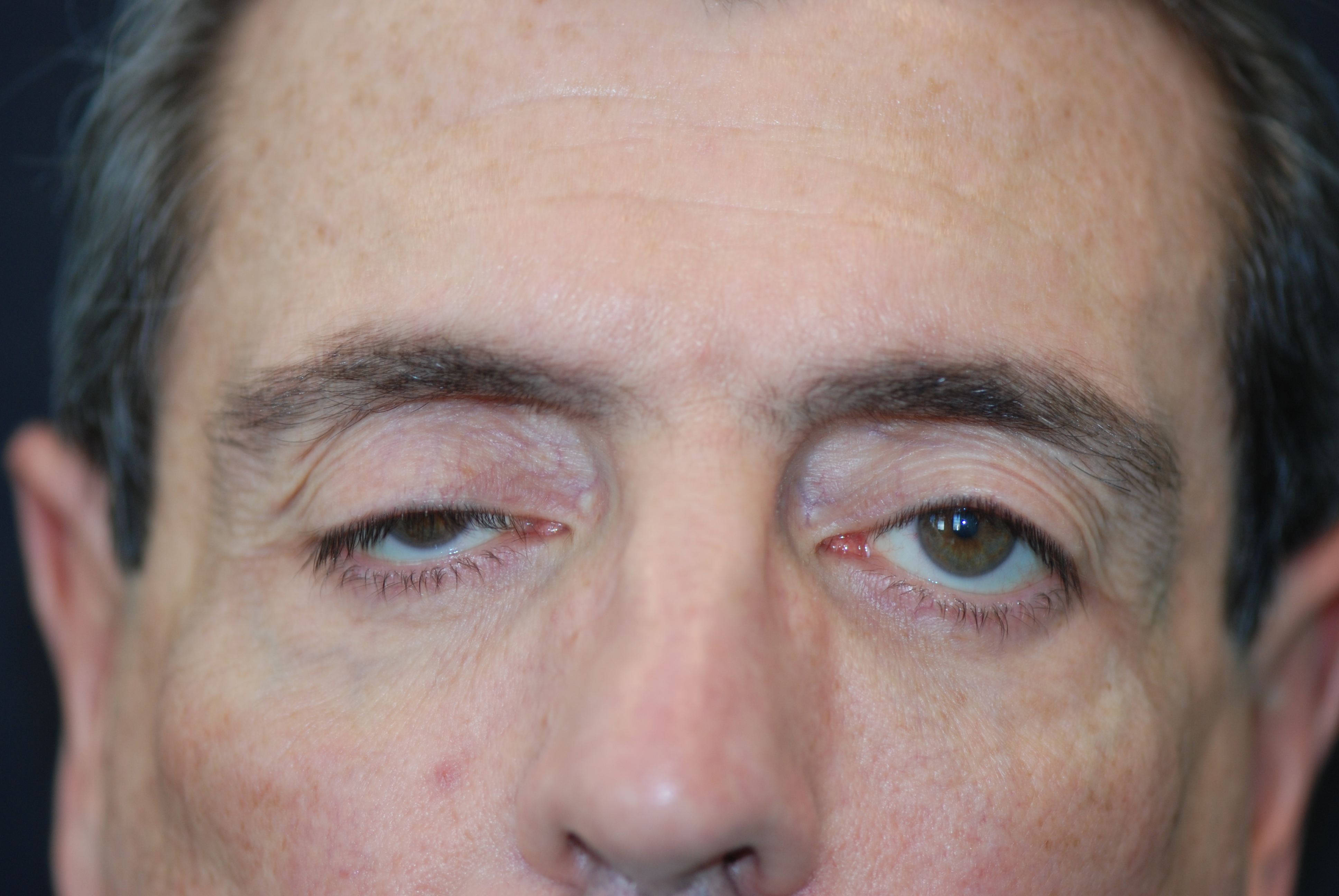 ptosis