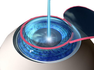 Cirugía Refractiva