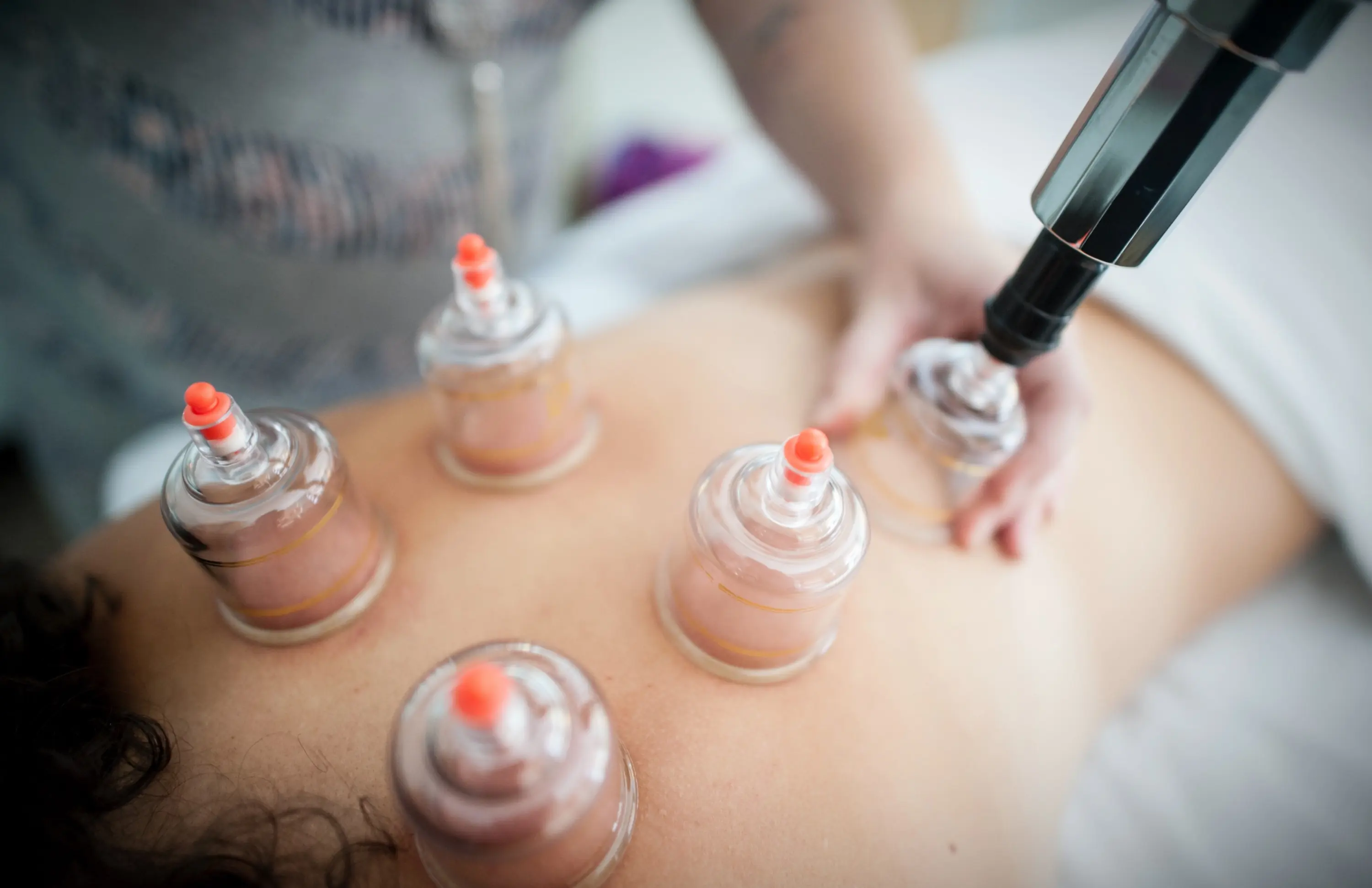 Myofascial Cupping