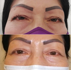 BLEFAROPLASTIA