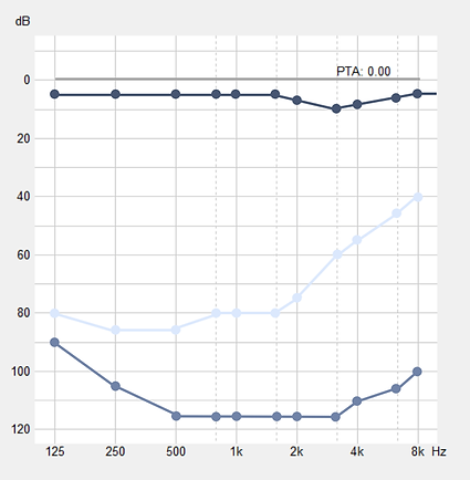 Diagnostiquer, tester, soigner hyperacousie. Méthode oreblue