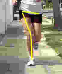 runner with poor femoral and pelvic alignment
