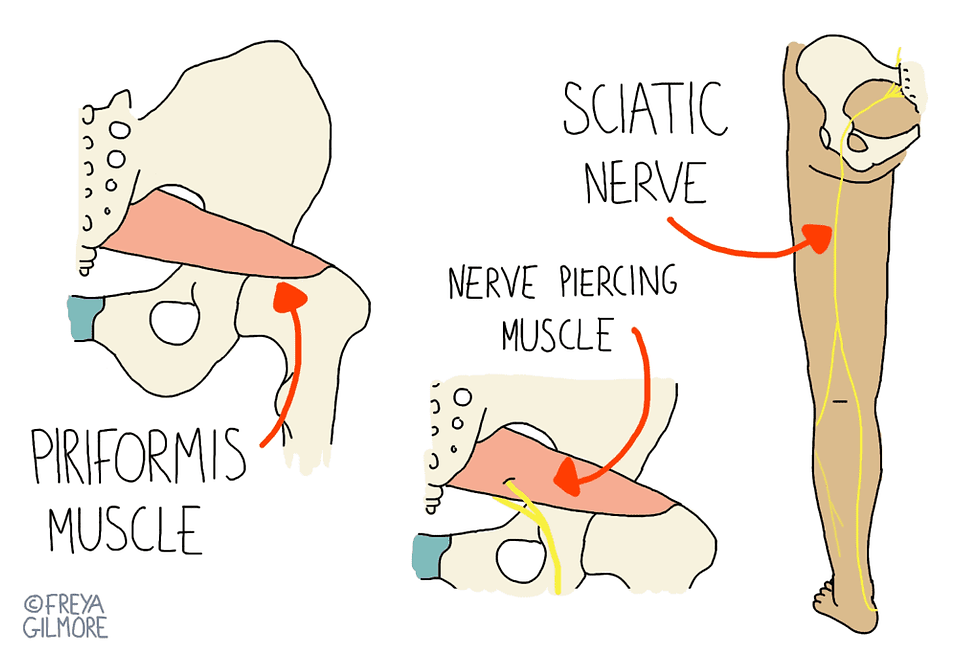 Sciatica