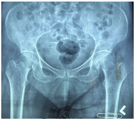 Figure 3 Pelvis X-ray