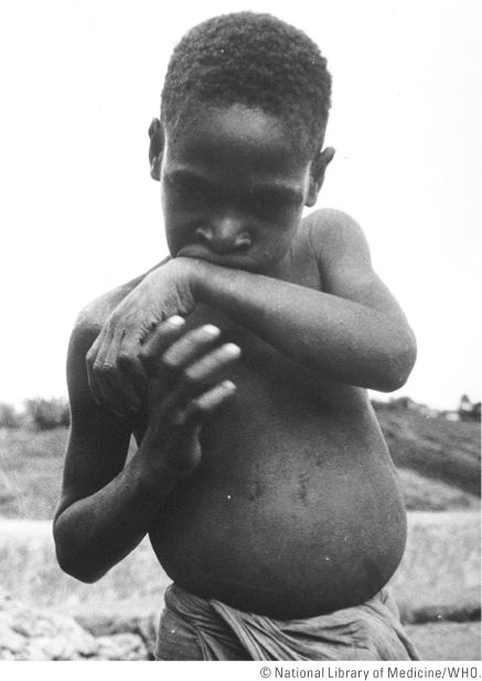 Kuru disease turning child into brain dead zombie