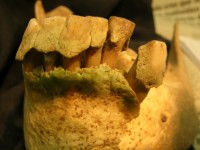 Thick plaque buildup on ancient teeth; photo by G. Richard Scott, University of Nevada, Reno